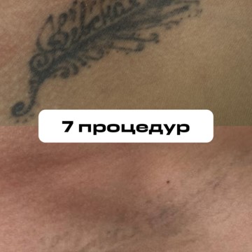 Клиника по удалению тату и татуажа Мити Цедермана фото 3