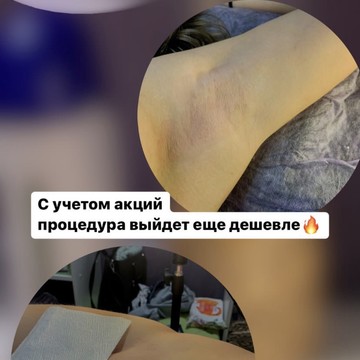 Восковая депиляция фото 3