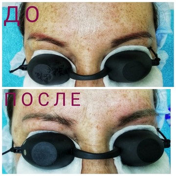 Лазерное удаление татуировок и татуажа фото 2