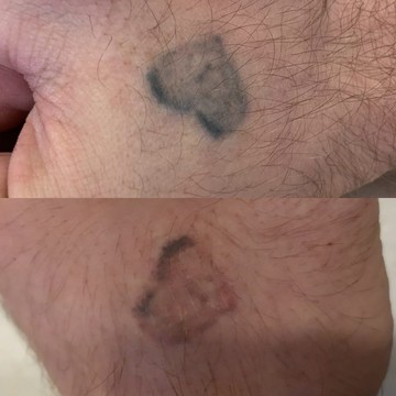 Студия удаления тату KHUSENOV_TATTOO.REMOVAL фото 1