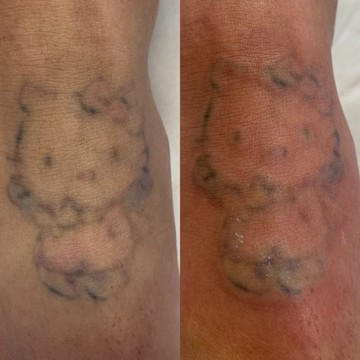 Студия удаления тату KHUSENOV_TATTOO.REMOVAL фото 3