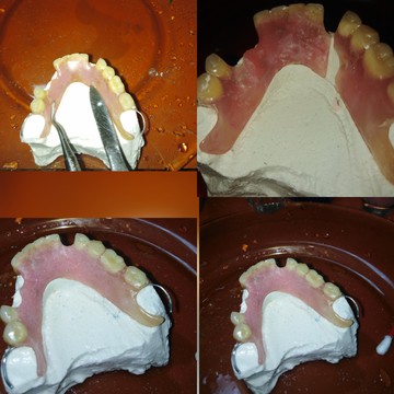 Ремонт съемных зубных протезов фото 1