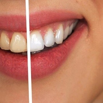 Студия отбеливания зубов Dental SPA studio фото 1