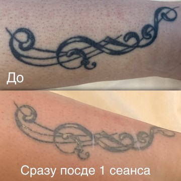 Студия удаления тату KHUSENOV_TATTOO.REMOVAL фото 2